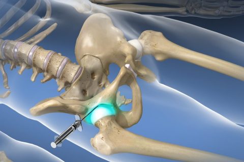 Fluoroscopic Guided Injection